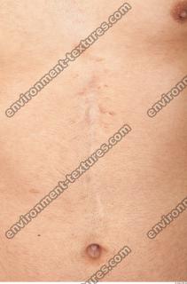 human skin scar 0003